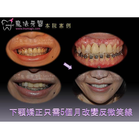 Teeth Correction