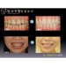 Orthognathic Surgery Recovery - Result of rare earth magnet
