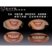 Full Mouth Dental Implants - Result of Pan