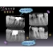 Root Canal Therapy - Result of Bamboo Flooring