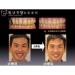 Gingival Flap Surgery - Result of key chain