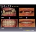 Missing Teeth - Result of dental