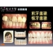Laser Tooth Whitening - Result of dental