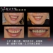 Dental Corrective Surgery - Result of dental