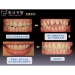 Temporary Dental Crown - Result of Photo Album